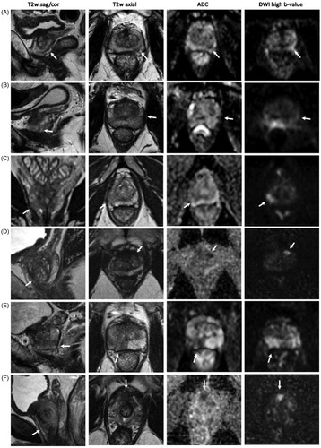 Figure 1. Magnetic resonance images from the six men whose cancer was upgraded on targeted biopsy. (A) PI-RADS 4 lesion peripheral zone, dorsolateral, left, apex, Gleason 3 + 4. (B) PI-RADS 3 lesion, peripheral zone, lateral, left, mid, Gleason 3 + 4. (C) PI-RADS 3 lesion, peripheral zone, dorsolateral, right, apex, Gleason 3 + 4. (D) PI-RADS 4 lesion, transition zone, anterolateral, left, apex, Gleason 3 + 4. (E) PI-RADS 5 lesion, peripheral zone, dorsal/dorsolateral, right, mid/apex, Gleason 4 + 3. (F) PI-RADS 4 lesion, peripheral zone, anterior, right, apex, Gleason 3 + 4.