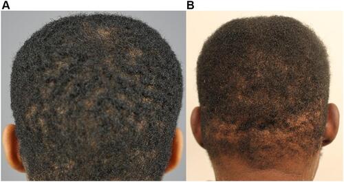 Figure 14 Posterior views of the scalps of patient 11 (A) and patient 2 (B) before shaving showing types 4a–b and 4c hair types, respectively.