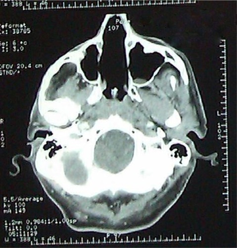 Figure 5 Postoperative computed tomography showing empty nasal cavities.