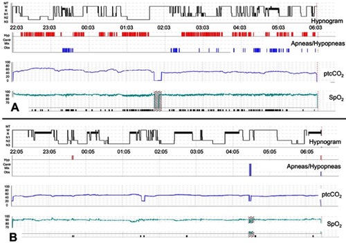 Figure 2 Polysomnography synopses from a 61-year-old non-ventilated patient with spinal onset ALS and clinically apparent respiratory muscle weakness before and after initiation of non-invasive ventilation (NIV). Both panels depict hypnogram, graphical presentation of apneas and hypopneas, transcutaneous capnometry, and pulse oxymetry (from top to bottom). (A) Sleep fragmentation with reduced sleep efficiency (65.6%), N3 percentage (13.3%), and REM percentage (6.1%). Sleep-disordered breathing is present, comprising severe obstructive sleep apnea (AHI 83.8/h, mean SpO2 88%) and nocturnal hypoventilation (mean ptcCO2 54.0 mmHg, maximum ptcCO2 63.7 mmHg). (B) Rapid improvement of objective sleep outcomes in the very first night of NIV treatment. Normalization of the AHI (0.3/h) and improvement of both CO2 elimination and oxygenation are evident (mean ptcCO2 52.0 mmHg, maximum ptcCO2 55.8 mmHg, mean SpO2 91%). In parallel, sleep architecture shows substantial increase of N3 and REM percentages (25.3% and 26.9%, respectively). Note that sleep-onset REM is present at the beginning of the night.