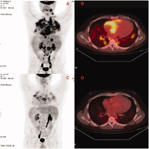 Figure 1. FDG-PET showing systemic localization of granulomas (Panel A), FDG cardiac uptake within the heart (Panel B), only few lung FDG uptake persistence after corticosteroid therapy (Panel C), no more cardiac uptake (Panel D).
