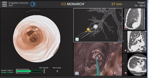 Figure 4 Monarch system interface displaying endobronchial, virtual bronchoscopic views, navigational pathway, preprocedural CT, and distance to target.