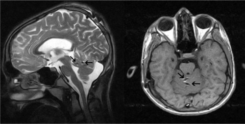 Figure 2 Postoperative axial T1 and sagittal T2 weighted magnetic resonance images show active contacts (arrows) of electrodes in the lobulus centralis and in the culmen of the anterior lobe of cerebellum.