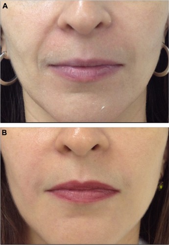 Figure 3 Patient 2 before (A) and after (B) Stylage® treatment.