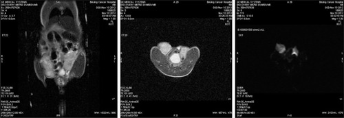 Figure 2 From left to right are the coronal, axial T2WI, and DWI images using 10 b values of 0, 10, 20, 50, 100, 200, 400, 600, 800, 1,000, 1,200, and 1,500 s/mm2.