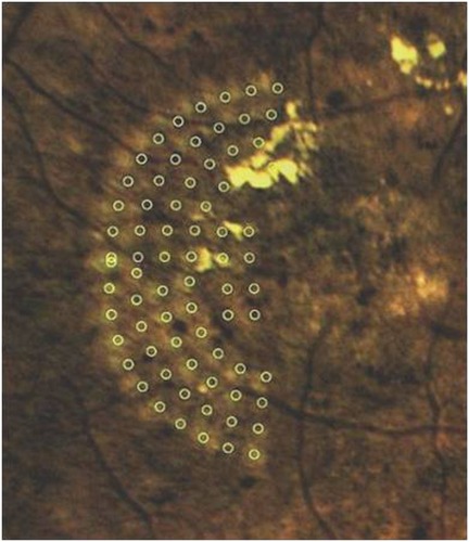 Figure 2 Pre-planned focal laser spots (circles) overlaid with post-processed color image 1 month after laser treatment with Navilas®.