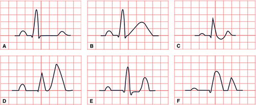 Figure 7 Classical ECG changes in electrolyte disturbances. (A) Hypocalcemia. (B) Hypercalcemia. (C) Hypokalemia. (D) Hyperkalemia. (E) Hypomagnesemia. (F) Hypermagnesemia.