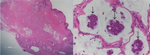 Figure 2 Histopathological findings from the specimen. Floating clumps of cuboidal cells with focal duct formation in the abundant mucin lakes (arrows) indicate a sweat gland adenocarcinoma.