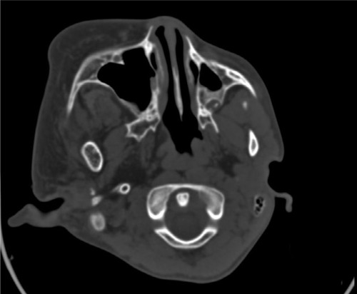 Figure 2 CT scan showing the enlarged pterygoid.