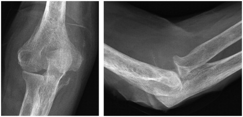 Figure 3. After 2 months; erosion at the olecranon and subluxation of the radial head.