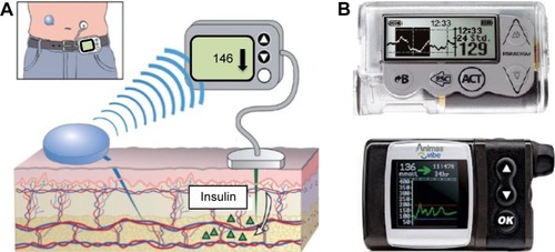 Figure 1 Sensor-augmented pump therapy.
