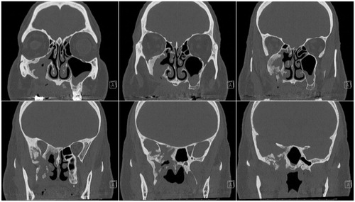 Figure 3. Post-operative computed coronal tomography with contrast at 3 months. Follow-up CT showing unchanged irregular sclerosis, fragmentation and expansion of the walls of the right maxillary sinus, right sphenoid sinus, right greater sphenoid wing and right pterygoid body, consistent with sequela of the patient’s biopsy-proven infected osteonecrosis status post therapy. The right orbital apex soft tissues showed near-resolution of attenuation and right lateral rectus muscle showed reduced enlargement relative to pre-operative CT, consistent with a response to therapy. No evidence of disease progression was observed.
