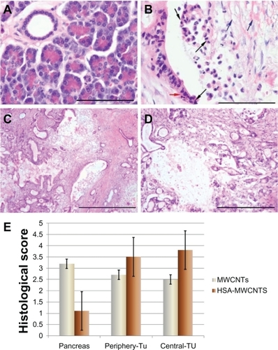 Figure 9 Histopathological aspects of the tissue after HSA-MWCNT intra-arterial administration and laser irradiation. A) Surrounding pancreatic tissue after irradiation. Normal acinar cells with staining polarity and pancreatic duct lined by cuboidal epithelium. No structural changes were observed. H&E stain, obx400 (scale bar represents 100 μm). B) Tumoral duct after irradiation. Distortion of the tumor structures, with loss of cell contact, piknotic and fragmented nuclei (black arrows); edematous extracellular matrix, disrupted, intense acidophilic fibers of collagen (blue arrows); apoptotic bodies (red arrow). H&E stain, obx40 (scale bar represents 100 μm). C) Periphery of the tumor. Foci of thermal lysis consisting of destructed tumoral ducts and desmoplastic reaction structures. H&E stain, obx4 (scale bar represents 1000 μm). D) Central area of the tumor. An extensive region of thermal lysis of cancer cells can be observed. H&E stain, obx10 (scale bar represents 400 μm). E) Histological scores of necrosis in healthy and malign tissue. Thermal injury was assessed in sections using a semiquantitative scale in which the percentage of necrotic areas was assigned a score: 0 = normal; 1 = <10%; 2 = 10%–50%; 3 = 50%–75%; 4 = >75%. Results are representative of three experiments.Abbreviations: H&E, hematoxylin and eosin stain; HSA, human serum albumin; MWCNT, multiwalled carbon nanotubes.