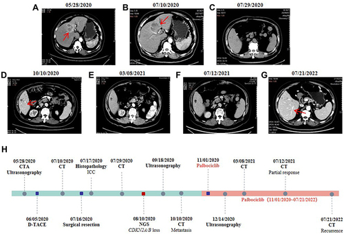 Figure 1 Representative upper abdominal imaging throughout the treatment period. (A) Preoperative CTA showed a lumpy mixed-density lesion in the liver with an unclear boundary with the gallbladder. (B) CT showed tumor cells was partially necrotic after D-TACE. (C) Postoperative CT showed new nodules in the S6 segment of the residual liver. (D) CT showed two small nodules in the S6 segment of the liver. (E) CT showed some shadows were smaller than before after palbociclib treatment. (F) CT showed a tumor reduction (reaching the criteria for a PR according to RECIST 1.1). (G) The latest CT showed the sign of recurrence. (H) The main clinical diagnosis and treatment process.