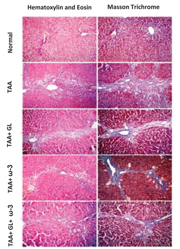 Figure 8. The left vertical panel showed marked necroinflammation in the TAA group that became reduced after combined treatment with (GL + ω-3) more than single treatment (arrows around bridging necrosis). The right panel showed increased collagen deposition in the TAA group with its reduction after combined treatment (GL + ω-3) more than single treatment (arrows around fibrous bridges).Thioacetamide (TAA), Glycyrrhizin (GL), Omega-3 fatty acids (ω-3) and (GL + ω-3) groups (magnification ×100).
