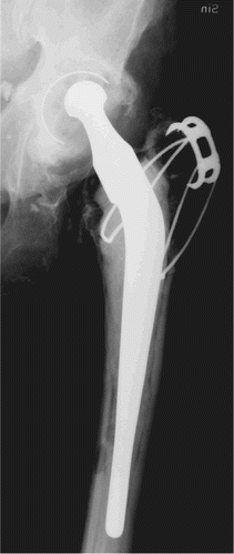 Figure 4. A hip with Charnley prosthesis.Primary surgery was performed in 1982 and the stem was revised in 1990.Severe polyethylene wear and zones (linear osteolysis) around the cup are present, with focal osteolysis around the distal part of the stem.