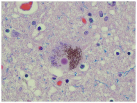 Figure 2 Photomicrograph of a hematoxylin-eosin-stained section taken from the substantia nigra pars compacta at autopsy of an individual with PD. A dopaminergic neuron in the center of the field contains a densely stained cytoplasmic Lewy body.