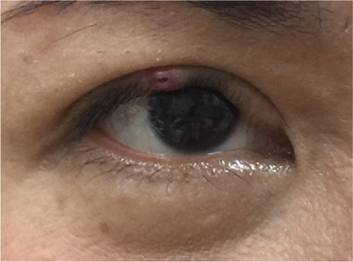 Figure 1 An elastic nodule with a crusted, poor-healing wound at the eyelid margin of the right eye.