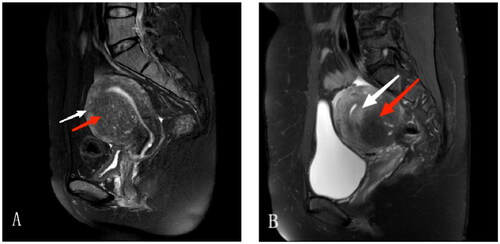 Figure 2. MRI features of internal and external adenomyosis. (A) Internal adenomyosis: a lesion with ill-defined margin located in the anterior wall of the uterus had developed in the thickened junctional zone (red arrow) and the myometrium outside the adenomyotic lesion was preserved. The thickness of the intact myometrium was 6 mm (white arrow). (B) External adenomyosis: a lesion with ill-defined margin (red arrow) located in the outer myometrium of the posterior wall of the uterus, the inner myometrium (the thickness was 8 mm, white arrow) between the adenomyotic lesion and the junctional zone was preserved, and the junctional zone was kept intact without aberrancy.