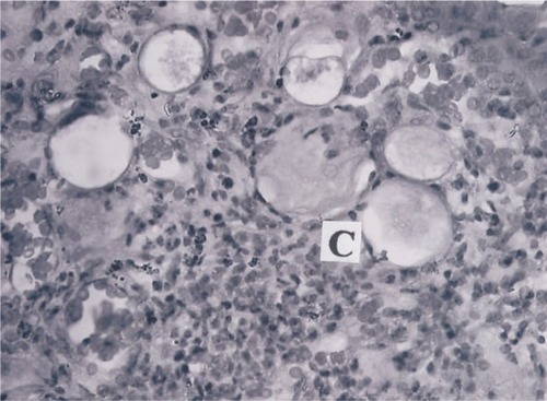 Figure 3 Histopathology of the rhinosporidial growth showing mononuclear cell infiltration and cystic areas (C) with thin, atypical, structureless walls enclosing amorphous eosinophilic material, which were initially identified as mucus cysts. Initial magnification × 400. H&E.