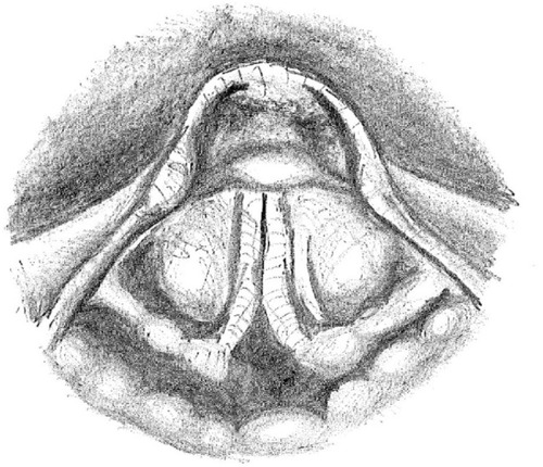 Figure 1 Typical adducted vocal cords with posterior glottic chink seen on laryngoscopy during stridor.
