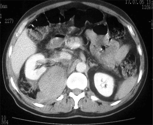 Figure 3. On contrast-enhanced abdominal CT image, right perirenal and retroperitoneal hemorrhage.