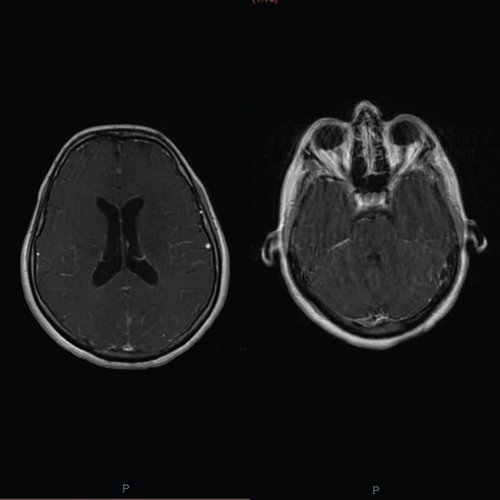 Figure 1. An MRI of the brain showing a diffuse leptomeningeal enhancement with hyperemia, compatible with the signs of meningitis.