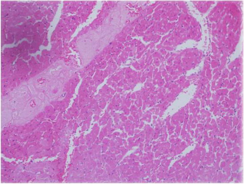 Fig. 4 Mild inflammatory cell infiltration and myonecrotic myocardial tissue in the diabetic ischemia reperfusion levosimendan group, HEx200.