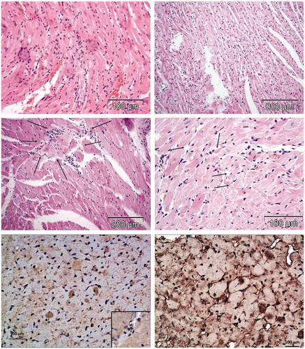 Figure 3. Histomorphological changes in the hearts of rats treated with DOX (HE stain). Rats treated with DOX had typical signs of cardiotoxicity: interstitial mononuclear infiltration, degeneration and diffuse necrosis of cardiomyocytes (upper left micrograph), loss of striation and interstitial hypercellularity (upper right micrograph); interstitial fibrosis (middle left micrograph) and vacuolar degeneration of cardiomyocytes (middle right micrograph). Lower micrographs illustrate expression of caspase 3 for detection of apoptosis in the heart tissue (insert shows lymphocytes).