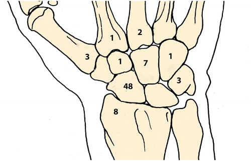 Figure 1. Distribution of 74 fractures diagnosed with MRI in 90 wrists.