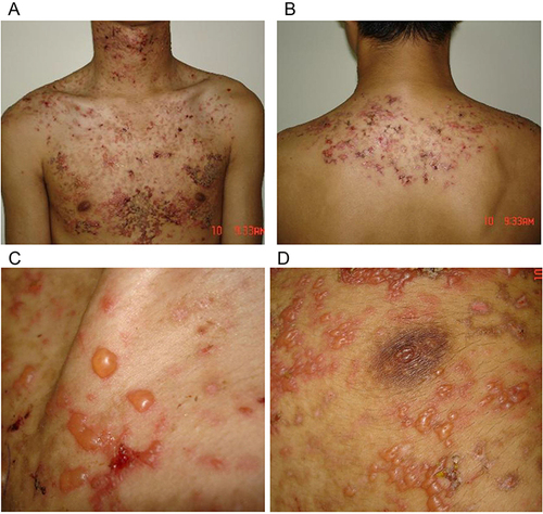 Figure 1 Dense distribution of round and oval edematous erythema is observed on the (A) neck, front chest, and (B) back. (C and D) Portions of the erythema show blisters with the size of mung bean to soybean. Moreover, the blisters have tense walls and clear fluid and are easy to break.