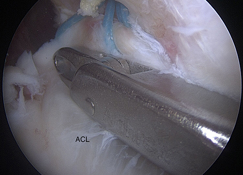 Figure 5 Arthroscopy, notch; ACL avulsion looped with DynacordTM suture.
