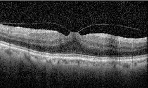 Figure 1 Optical coherence tomography of vitreomacular traction. That is by definition a structural abnormality, which causes focal, tractional, distortion of the macula.