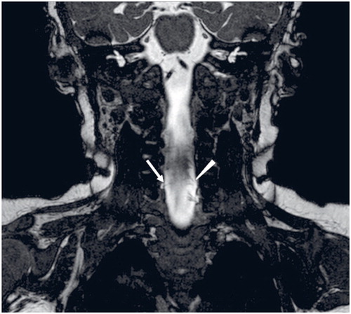 Figure 3. Coronal BFFE image (0.5 mm) in a 3-month-old girl (patient 16) with brachial plexus birth injury on the right side. Right ventral C6 root is thinned (arrow) compared to the normal left ventral C6 root (arrowhead).