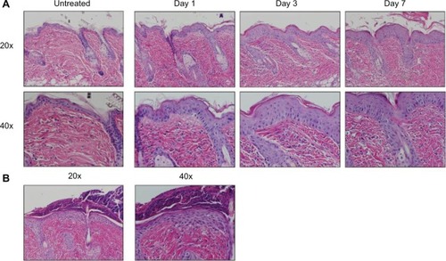 Figure 2 AD characteristic histologic changes in OVA challenged mice. (A) Histology was analyzed at 1, 3, and 7 days of challenge and compared to skin of untreated mice, revealing a progression of characteristic histologic changes, including acanthosis, spongiosis, hyperkeratosis, dermal inflammation, and dermal thickening. Images, shown at 20× (upper) and 40× (lower) magnifications, are representative of three mice per time point. (B) Secondary changes included erosion, crust, and impetiginization.Abbreviations: AD, atopic dermatitis; OVA, ovalbumin.