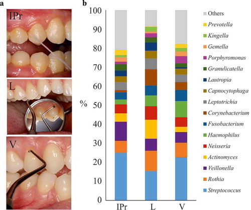 Figure 1. Bacterial composition at interproximal sites and their associated vestibular and lingual surfaces. (a). Dental floss sampling at the interproximal (IPr) region between teeth 1.4 and 1.5, and sampling of supragingival dental plaque at vestibular and lingual surfaces with an autoclaved spoon excavator. The pictures are merely illustrative and were taken from a different patient which was not part of the study. (b). Bacterial community composition at genus level in the three sampled regions, as determined by 16S rRNA gene Illumina sequencing