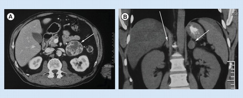 Figure 2. Computed tomography imaging of pheochromocytoma.(A) Left pheochromocytoma. Abdominal CT scan from an asymptomatic man aged 65 years showing a heterogenous left adrenal mass, 6 cm (arrow). (B) Bilateral pheochromocytoma. Abdominal CT scan from a man aged 35 years with known MEN2, showing a left adrenal mass, 2 cm with density of >25 Hounsfield units (thick arrow), and thickened medial limb of the right adrenal gland (thin arrow).