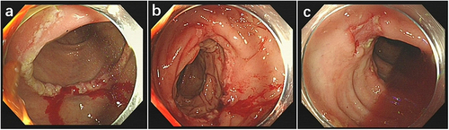 Figure 2 (a–c) Early onset transverse colonic ulcers with spontaneous bleeding, multiple ulcers inside the descending colon.