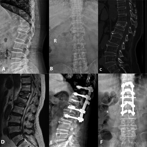 Figure 3. Case 2. PSV + VP. A 69-years old female patient complained refractory low back pain with functional dyspepsia which was persistent for about 6 months without any injury. A-B: X-ray at admission demonstrated L1 compression fracture with narrowed L1/2 disk space. C: Preoperative CT sagittal reconstruction show L1 collapse and intra-vertebral vacuum cleft with upper endplate fracture. D: MRI at admission showed severe compressed intra-vertebral vacuum cleft of L2, L1/2 disk space at T2 WI show disk injury with heterogeneous signal. E-F,G: Postoperative X-ray and CT sagittal reconstruction show adequate cement distribution in the injured vertebra, with bone cement reinforced screws fixation at the adjacent vertebrae.