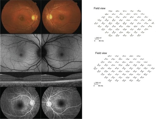 Figure 1 Fundus photograph of the patient.