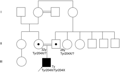 Figure 1 Family tree of the patient with OI type XI.