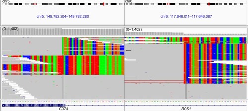 Figure 3 The IGV screenshots display the reads from next-generation sequencing and reveal harbouring of CD74–ROS1 fusion.