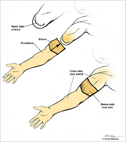 Figure 7. Fitting of the donor prosthesis. The donor stump is closed to achieve a water-tight seal. The sleeve on the proximal segment of the prosthesis is rolled over the stump.