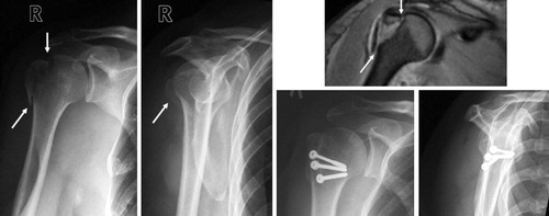 Figure 2. Patient no. 9 (Table 3) before and after open reduction and internal fixation with cannulated screws of a moderately displaced fracture of the greater tuberosity (white arrows). An MRI scan illustrates the fracture line (white arrows).