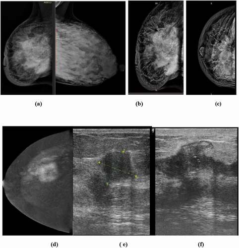 Figure 4. 32 years old lactating patient complaining of fever and right sided inflammation of the breast; (a) Medio-lateral oblique DM images of both breasts revealed right sided diffuse skin and trabecular thickening with suspicious pleomorphic segmental calcifications, (b &c) Cranio-caudal and medio-lateral oblique DBT images of right breast revealed ill-defined sizable heterogeneous mass lesion with focal retraction (tenting) of the posterior retro mammary fat and suspicious segmental calcifications, (d) CESM reveals a heterogeneously enhancing ill-defined mass lesion with related non-mass enhancement surrounding the index lesion, (e&f) Ultrasound revealed multiple ill-defined hypo-echoic masses with overlying calcifications with intervening suspicious dilated ducts. US core biopsy revealed multifocal infiltrating ductal carcinoma