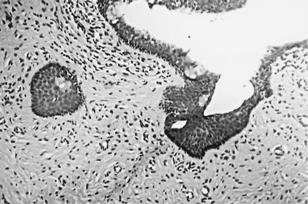1 Mature epithelial nests and cysts, containing squamous, respiratory, and simple epithelia, embedded within mature fibrous mesenchymal tissue (H&E, ×200).