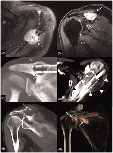 Figure 2. Curative cryoablation of a solitary scapular metastasis of a papillary thyroid cancer in a 63-year-old male patient. Axial Short Tau Inversion Recovery (STIR) (A) and coronal T1 weighted (T1W) contrast enhanced (B) MR acquisitions (A, B) show the metastatic lesion of the scapular spine (white arrows). Multiplanar reconstructed CT images (C) display the positioning of 4 cryoprobes along the long axis of the lytic lesion (white arrows). Axial CT image (D) shows the maximal iceball (arrow heads); in this case, the supraspinatus muscle was hydrodissected (black arrow). A hydrodissection of the suprascapular nerve was also performed with a 22 G needle placed in the suprascapular notch (not shown). In this patient, a symptomatic post-ablation fracture occurred 1 month after the procedure as shown on coronal CT reconstructions (arrows in E). This fracture was treated by percutaneous screw fixation (arrows in F).