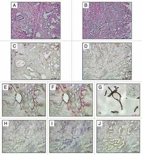 Figure 1 Representative photomicrographs of matched Hematoxylin and Eosin stained frozen sections of benign (A) and malignant (B) prostatic tissues and CD31 immunostained frozen sections of benign (C, E and F) and malignant (D, H–J) prostatic tissues prepared for LMD. The benign prostatic tissue shows stromal and glandular hyperplasia and the malignant prostatic tissue shows well-differentiated adenocarcinoma. Endothelial cells are highlighted by CD31 immunostaining of matched benign (C) and malignant (D) prostate frozen tissue on a PEN membrane slides. It was a common observation that malignant prostatic tissues had higher microvascular density than benign prostatic tissues. (E and H) represent CD31 immunostained tissue sections before microdissection. (F and I) represent outlined endothelium to be dissected. (G) represents captured endothelium from the slide in a collection cap. (J) represents the remaining tissue sections after microdissection.