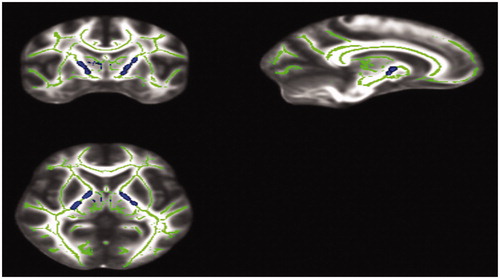 Figure 1. Group differences in factional anisotropy (FA) between 24 patients with SCT + ADHD-IA and 24 TD subjects. Significantly increased FA in patients with SCT + ADHD-IA were shown in the bilateral anterior and posterior limb of internal capsule, bilateral cerebral peduncle and the fornix. Represented results are thresholded at a p < .05 (TFCE corrected). See Table 2 for cluster details.