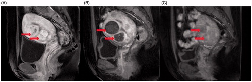 Figure 2. Contrast-enhanced MR images from a 36 years old patient with multiple uterine fibroids. (A). A sagittal view image obtained before HIFU treatment showed the size of uterus was 9.6 × 7.6 × 7.0 cm3, multiple uterine fibroids were detected (arrows). (B). A sagittal view image obtained one day after HIFU showed the fibroids were completely ablated (arrows). (C). A sagittal view image obtained 6 months after HIFU showed the size of uterus was 8.0 × 7.3 × 6.4 cm3, the rate of fibroid volume reduction was 89.6% (arrows).